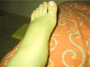 Симптомы отеков во время беременности Профилактика отеков во время беременности