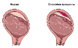 Отслоение плаценты Отслоение плаценты