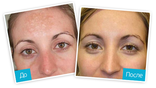 Отбеливающий пилинг для лица ПНГШНЛ.jpg