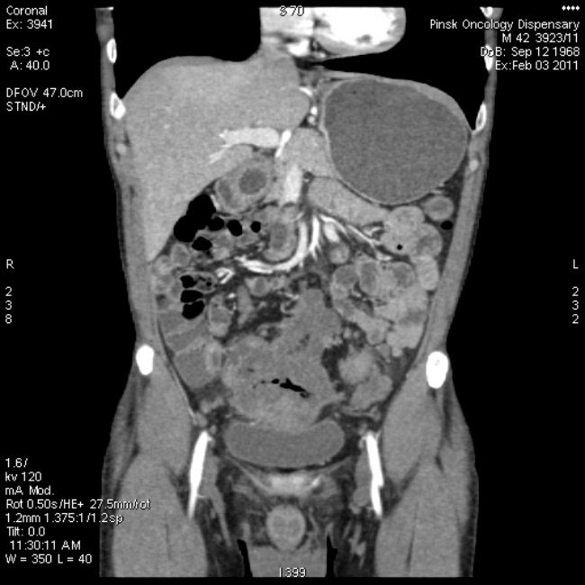 аденокарциома сигмовидной кишки на КТ