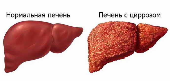 Что такое цирроз печени