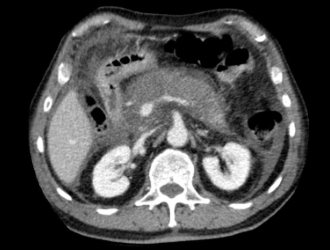 Диагностика острого панкреатита с помощью МРТ