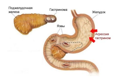 Гастринома