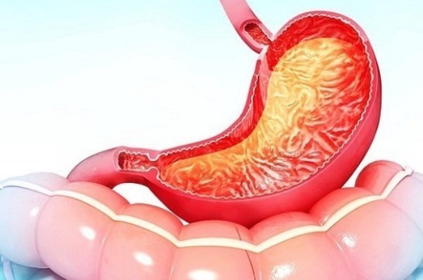 Гастрит желудка