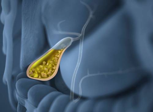 Холецистит