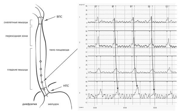 Исследование двигательной функции пищевода. Перистальтическая волна распространяется с градиентом в дистальном направлении от 1 к 4 датчику