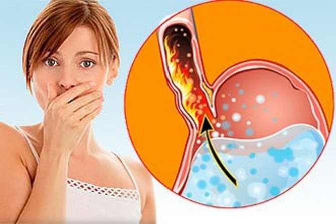 Изжога в горле: причины, симптомы и лечение