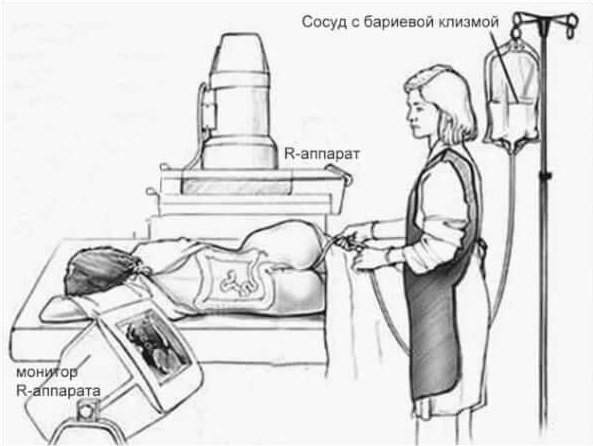 Как пить фортранс перед ирригоскопией