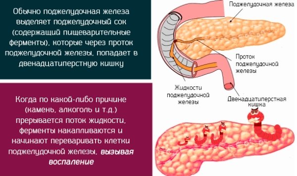Как возникает острый панкреатит.