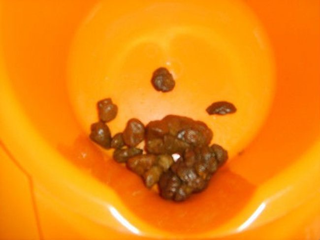 Кал камушками причины