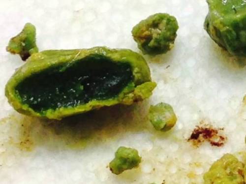 Камни в печени