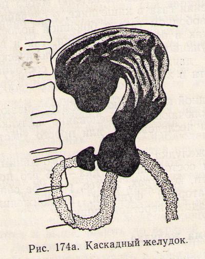 каскадный желудок у человека