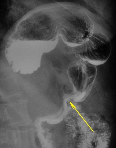 Каскадный желудок