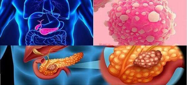 Лечение доброкачественных опухолей поджелудочной железы