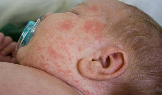 Лямблиоз у детей, высыпания фото