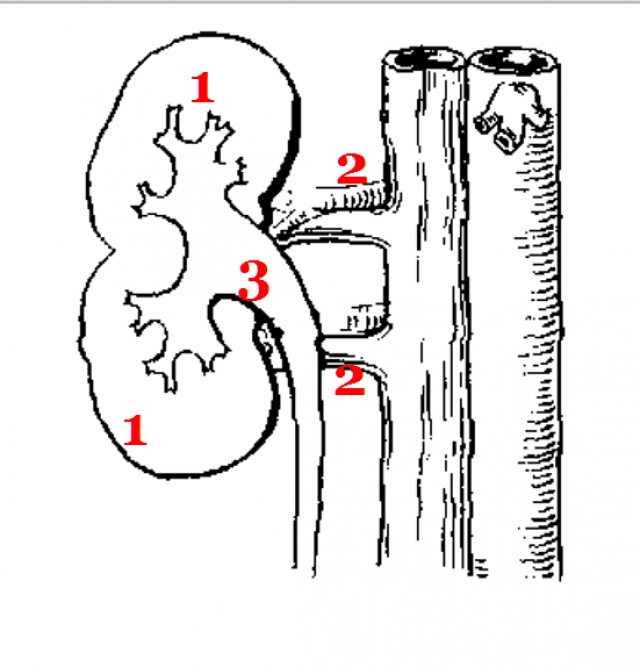 Неполное удвоение почки (схема)