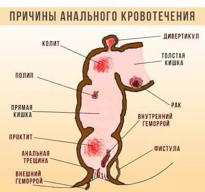 Несколько причин кровотечения