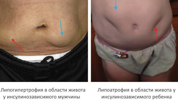 Образования на коже от инъекций