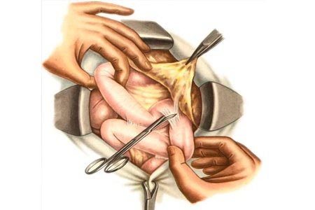 петля в кишечнике