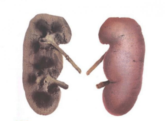Полностью удвоенная почка