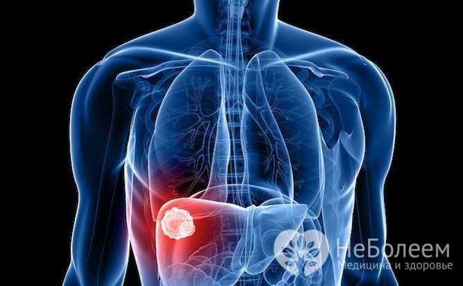 При альвеококкозе в печения появляется паразитарная опухоль, способная метастазировать в легкие, головной мозг и прочие органы