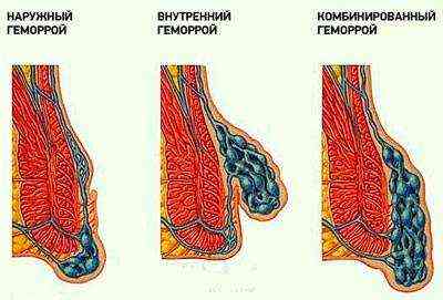 при опорожнении кишечника болит низ живота