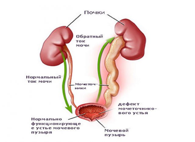 Схема пузырно-мочеточникового рефлюкса