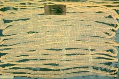 Широкий лентец: симптомы у человека, лечение дифиллоботриоза