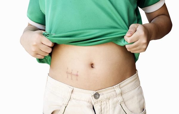 шрам от аппендицита