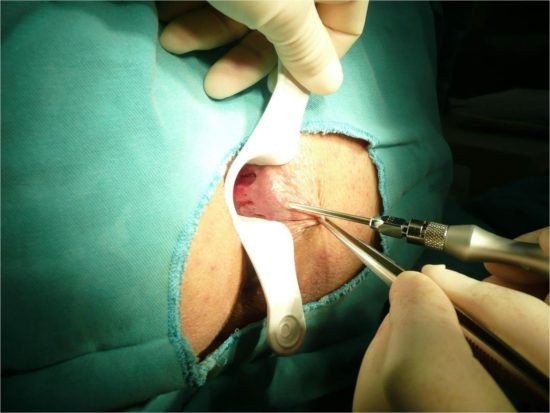 Сколько заживает рана после удаления геморроя