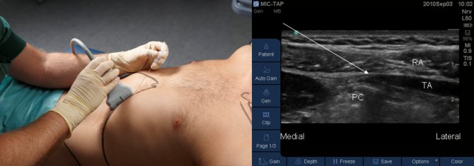 слева изображен процесс выполнения пункции, справа ультразвуковое изображение