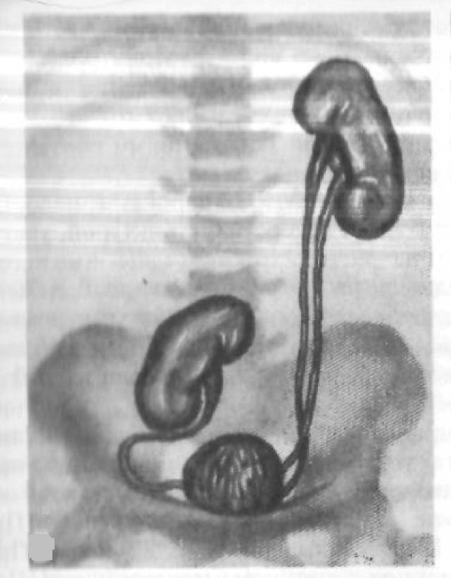 Сочетание удвоения левой почки с неправильным положением правой