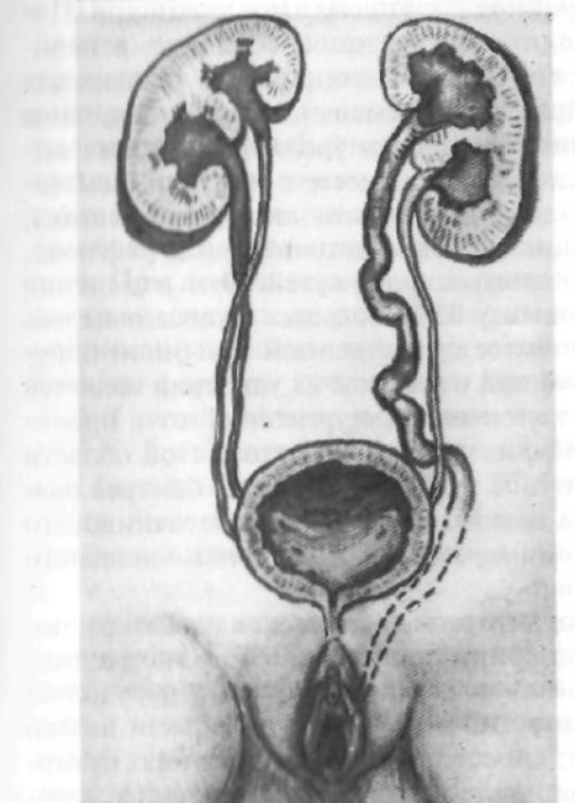 Сочетание удвоения почек и мочеточников с открытием верхнего ствола левой половинки в уретру