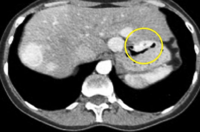 Светлые образования на томограмме