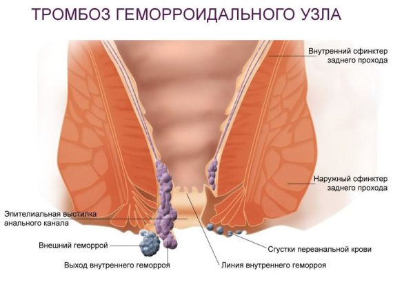 тромбоз узла фото картинка