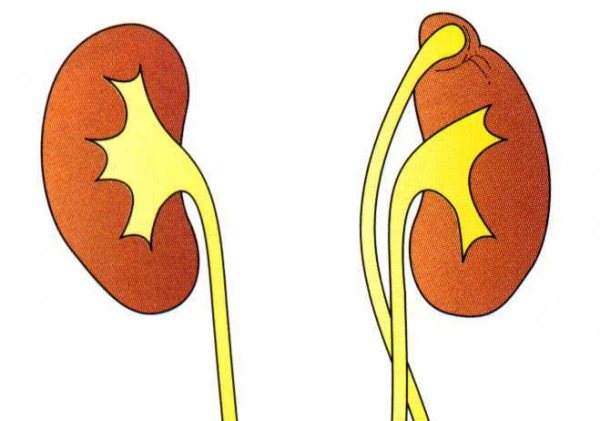 Удвоение почки - что это такое и причины