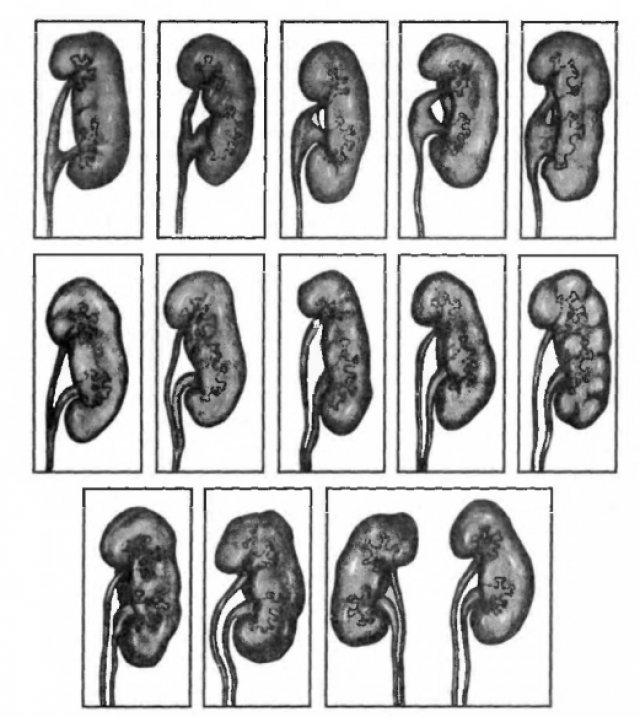 Варианты удвоения почек