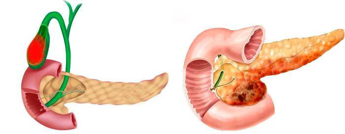 Воспаление поджелудочной железы и ЖП