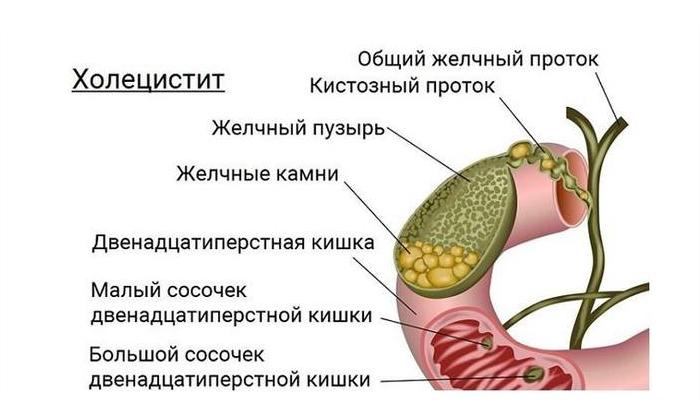 Воспаление желчного пузыря