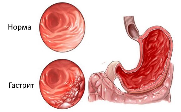 Воспаление желудка